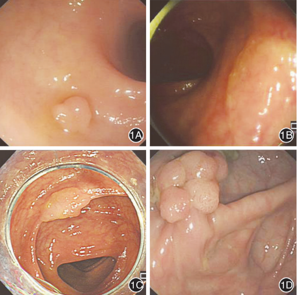 【202105综述】结直肠锯齿状病变的癌变机制及内镜诊断研究进展