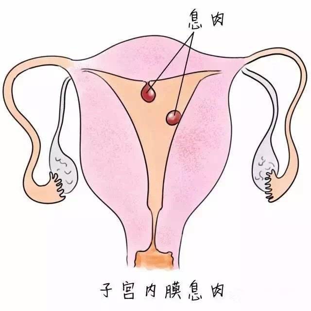 云南京华妇科医院讲解:子宫息肉的危害都有哪些表现