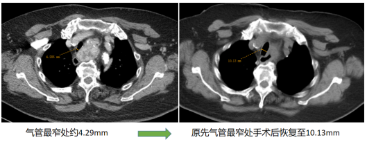 术后为了避免直接拔除气管插管有气管塌陷的风险,李奶奶转入icu病房