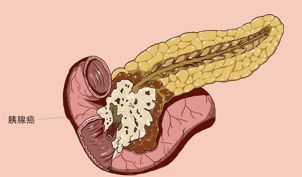 什么是胰腺炎胰腺有炎症时身体会出现哪些症状