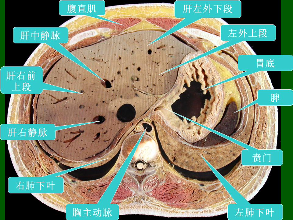 高清人体腹部断层解剖图谱,必须收藏