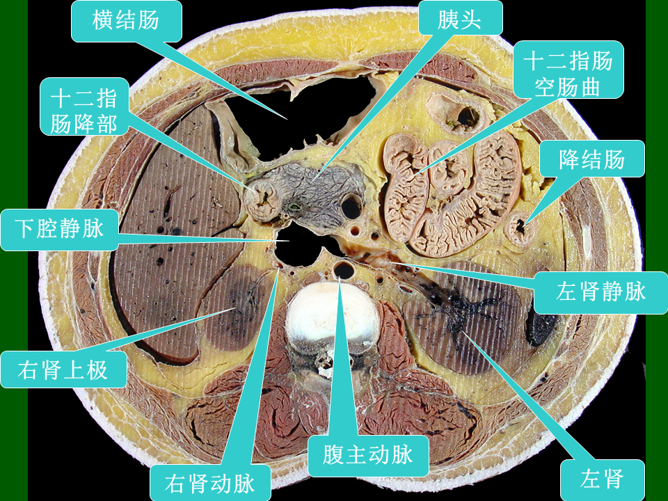 高清人体腹部断层解剖图谱,必须收藏