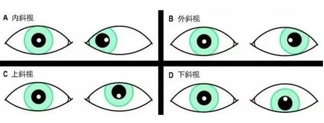3岁儿子确诊斜视加散光,父母视力问题会遗传,尽早干预