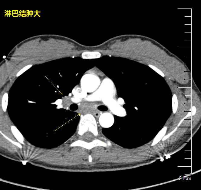 图6-12 结节 卫星病灶 纵隔淋巴结多发肿大 年轻人,首先考虑结核.