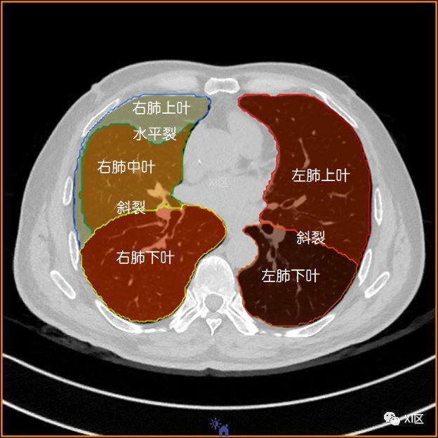 气管支气管树与两肺融合显示 肺的分叶 左
