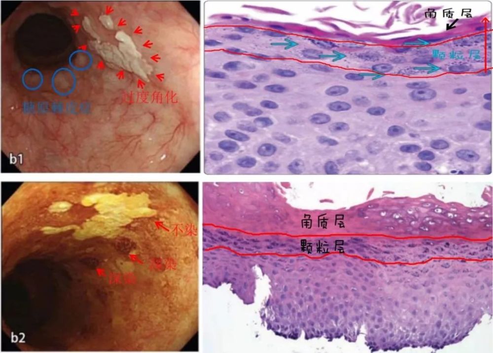 正常的食管鳞状上皮层是没有颗粒层和角质层的,食管表浅癌表面伴有的