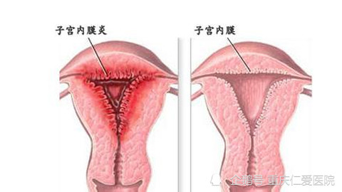 重庆仁爱妇科医院讲解:预防急性子宫内膜炎的方法