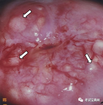 61 行子宫颈管搔刮术,病理确诊子宫颈肥大需与子宫颈腺癌鉴别