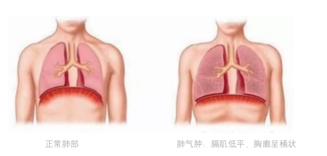 有网友留言:慢阻肺和肺部通气功能受限是不是一回事?