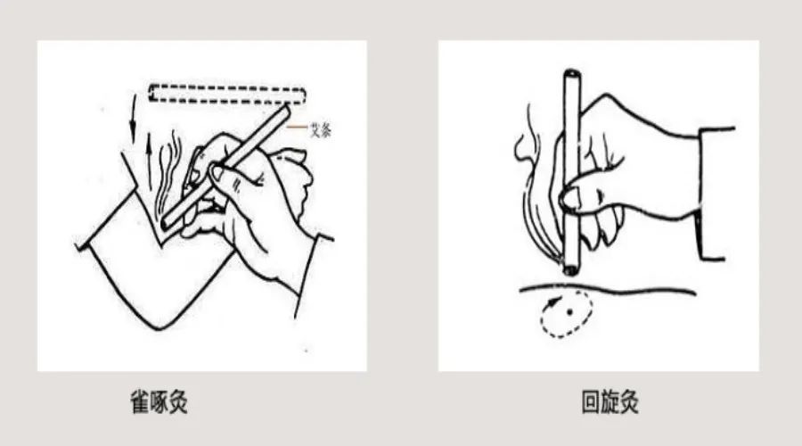 最后,雀啄灸为泻法,回旋灸为补法.