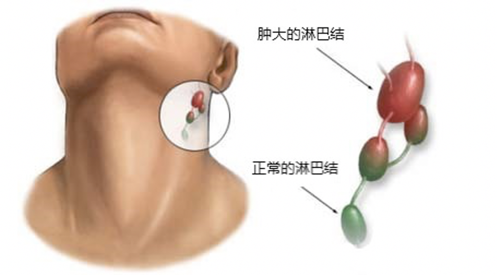 淋巴结肿大是炎症还是癌症