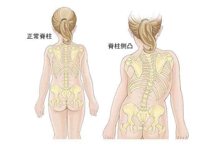 睡姿不当导致脊柱侧弯?哪些姿势最伤脊柱,应该如何呵护脊柱?