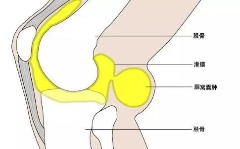 膝关节肿了疼了就是滑膜炎吗