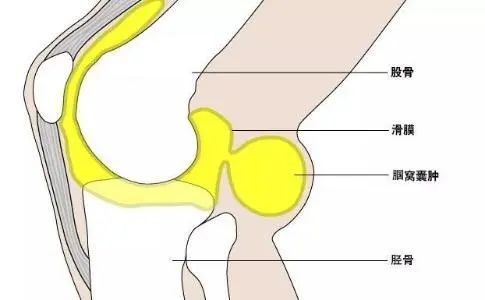 因关节退变,磨损导致关节腔积液,通过后关节囊薄弱区达膝关节后侧,较