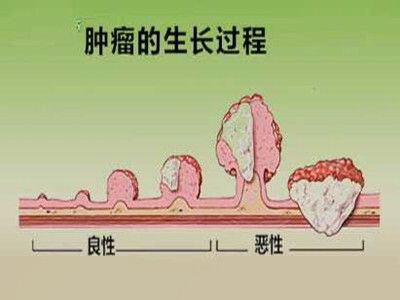 肿瘤是指机体在各种致瘤因素作用下,局部组织的细胞异常增生而形成的