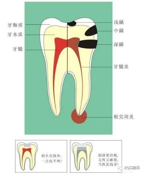 根尖周炎在牙疼发展到牙髓炎阶段的时候,相信有很多朋友已经忍受不了