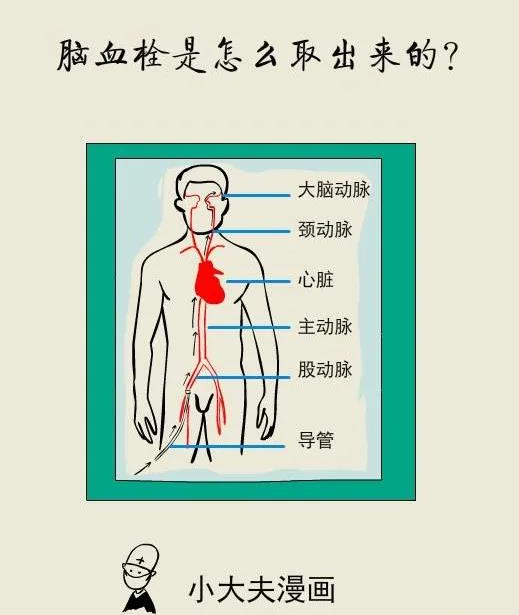图说疾病|几张图告诉您,脑血栓是怎么通过微创的方式取栓