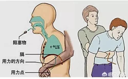 食物卡住喉咙该怎么办海姆立克急救法真的有效吗