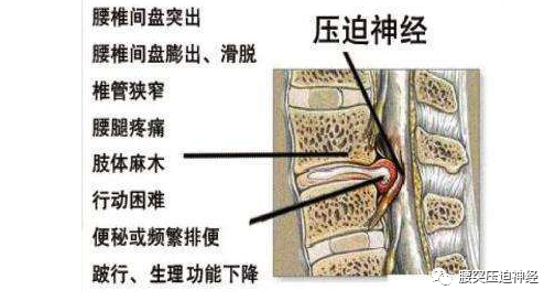 腰椎间盘突出的手术指征