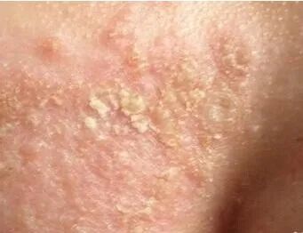 【肤康·科普】正确区分湿疹和皮炎,摆脱皮肤病的干扰