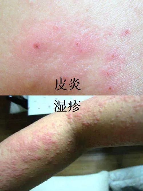 肤康科普正确区分湿疹和皮炎摆脱皮肤病的干扰