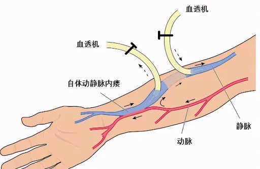 与自体动静脉内瘘相比,术后感染风险较高.