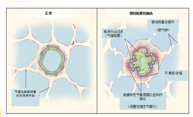 立秋后,慢阻肺患者做好这三件事可减少急性发作!