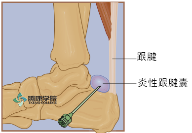 疼痛解剖学|跟腱囊