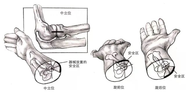 【骨科小技巧】桡骨小头骨折的复位与固定!