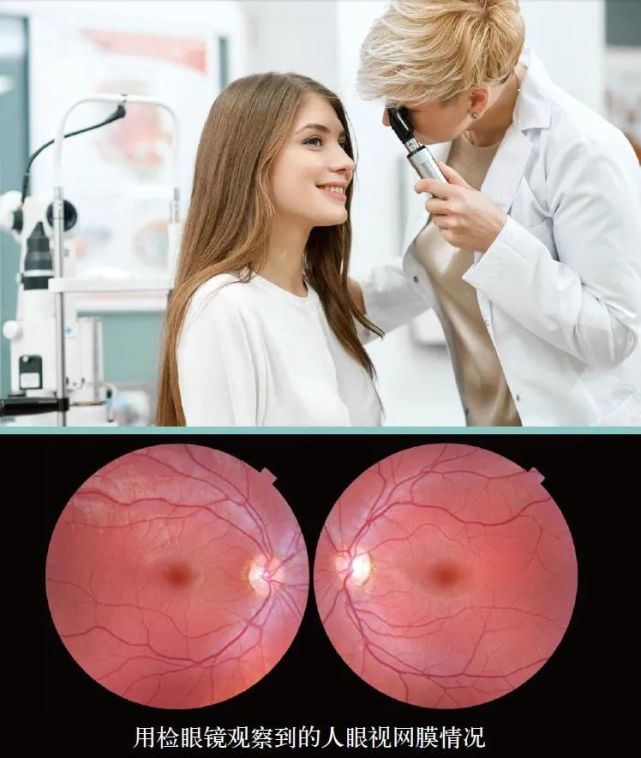 检眼镜:检查视网膜
