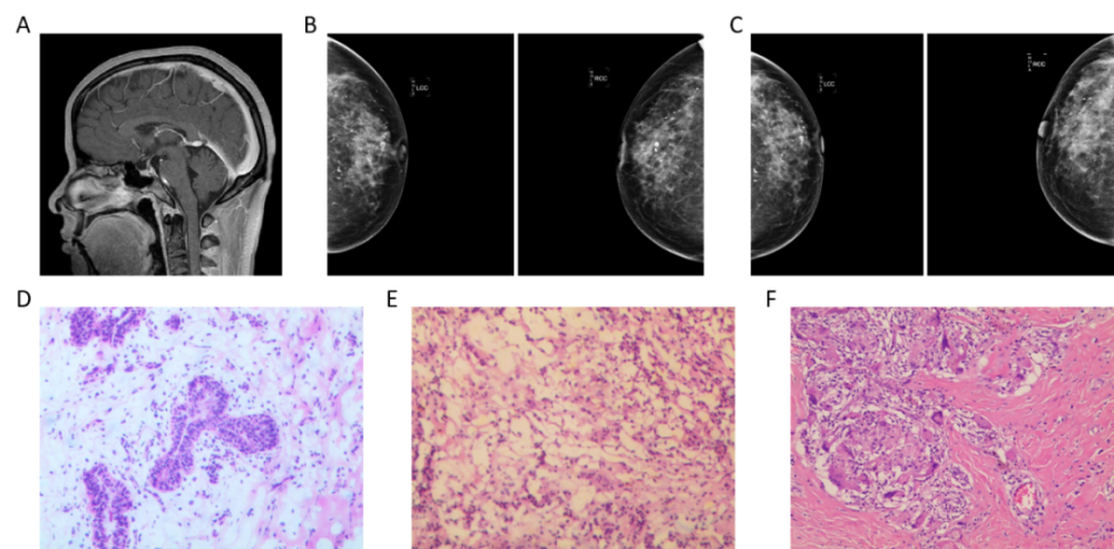 浆细胞性乳腺炎的风向标——血清泌乳素|全国检验与临床思维案例