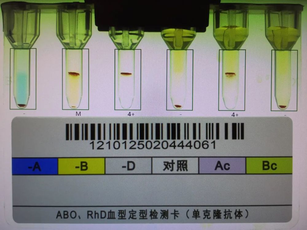 正定抗-b孔混合凝集,其抗筛及与患者的交叉配血结果均为阴性