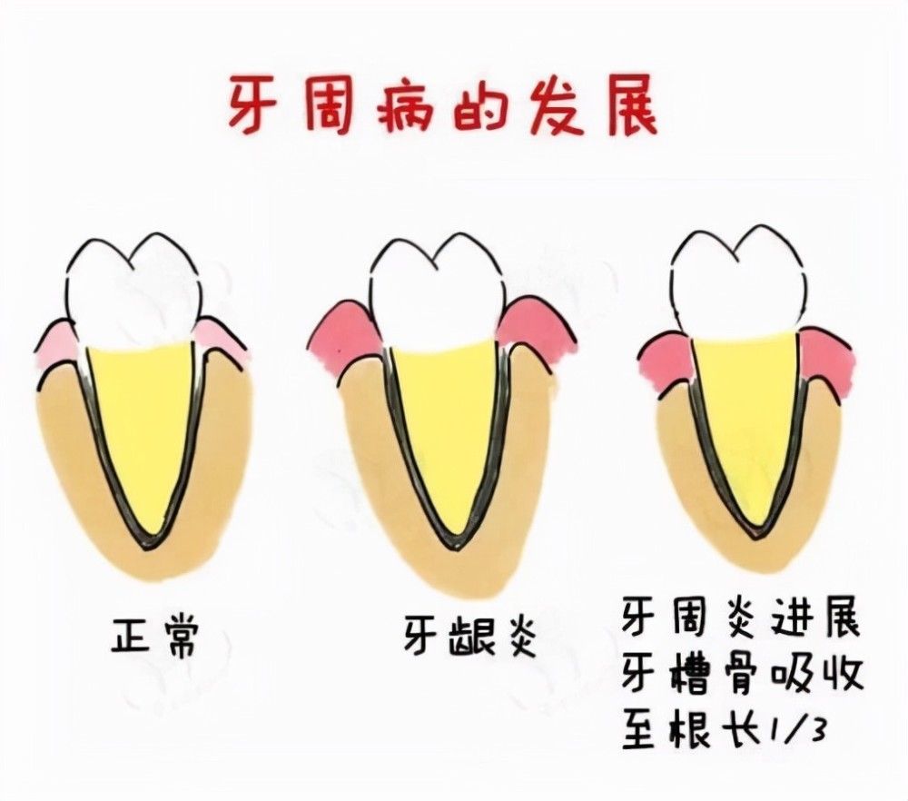 龋齿只会毁掉你一颗牙而毁掉你整口牙的是牙周炎