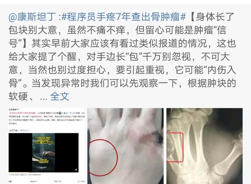 手上长了个肿块不疼不痒竟是个肿瘤