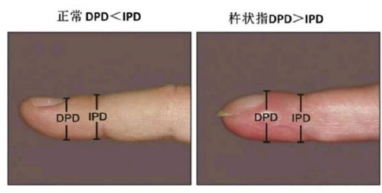 手指肿的像鼓槌小心杵状指