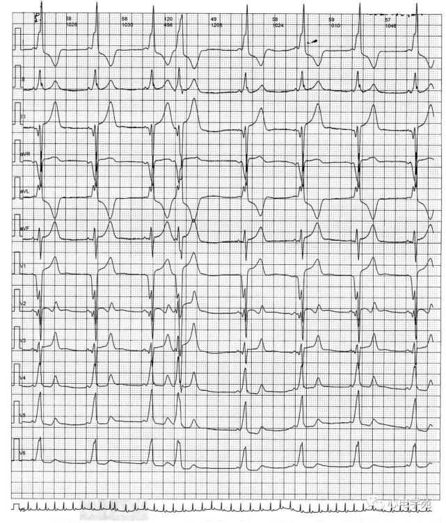 01临床资料 男性,31岁,间断心悸10月,心电图示室上性心动过速.
