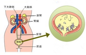 尿道进入膀胱的,这一类比较常见,婴儿期,妊娠期,新婚期的女性更易发生