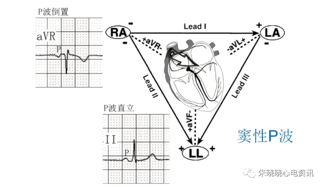 形成这两个特征的原因与心脏解剖学相关,窦房结位于上腔静脉和右心房