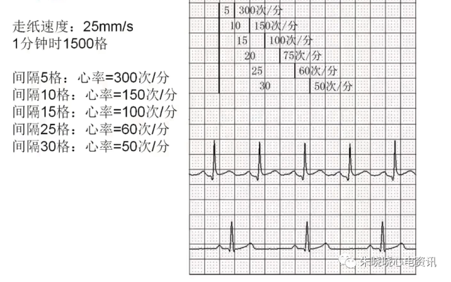 心律失常心电图分析,牢记两项"金规则"