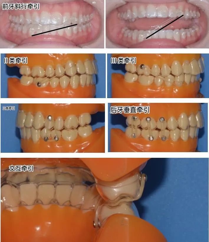 以上颌(上牙弓)或下颌(下牙弓)作为支抗来矫正对颌牙,或是以上下颌间