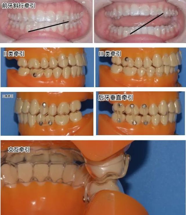 (下牙弓)作为支抗来矫正对颌牙,或是以上下颌间的交互牵引来调整覆合