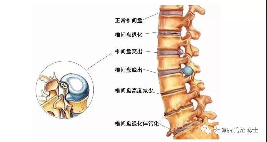 这是腰椎骨之间腰间盘发生退行性改变或者由于急性外伤导致纤维环