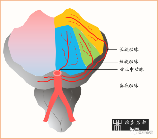 图解脑桥梗死豆纹动脉梗死机制解剖和示意图