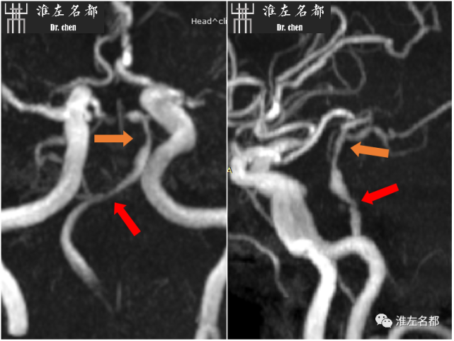 基底动脉管壁mri(t2wi和增强t1wi:脑桥梗死层面,基底动脉左侧管壁