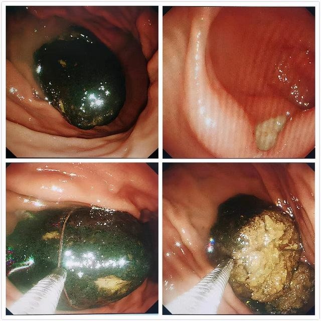 胃柿石 腾讯网