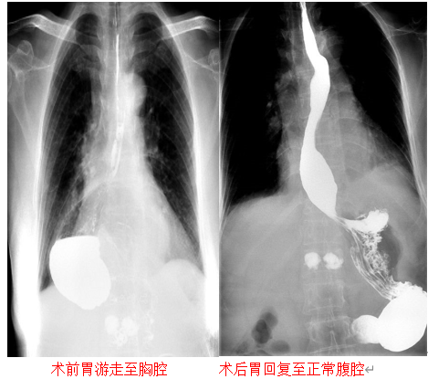 重庆市人民医院:为患者寻回"离家出走的胃"