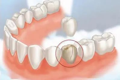 如果不戴牙冠,在不小心咬到硬物时,牙齿就容易发生劈裂,劈裂了就有