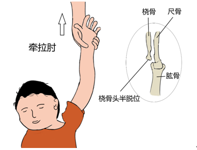 小孩子的桡骨小头容易脱位,如果是脱臼,孩子的肘关节一直呈伸直状态