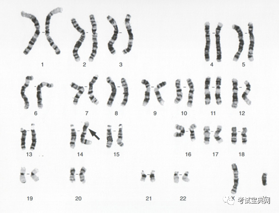 易位型ds核型患儿细胞中呈现3个21号染色体的荧光信号01 荧光原位