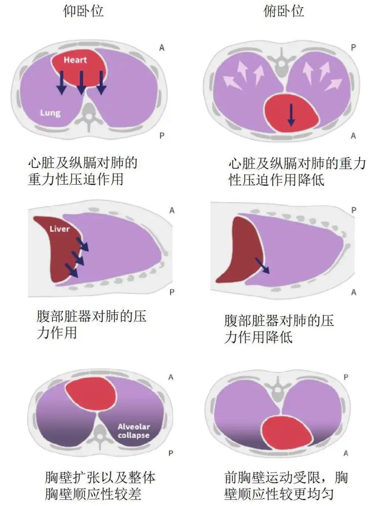 【医线动态】俯卧位通气—重症医学救治之利剑